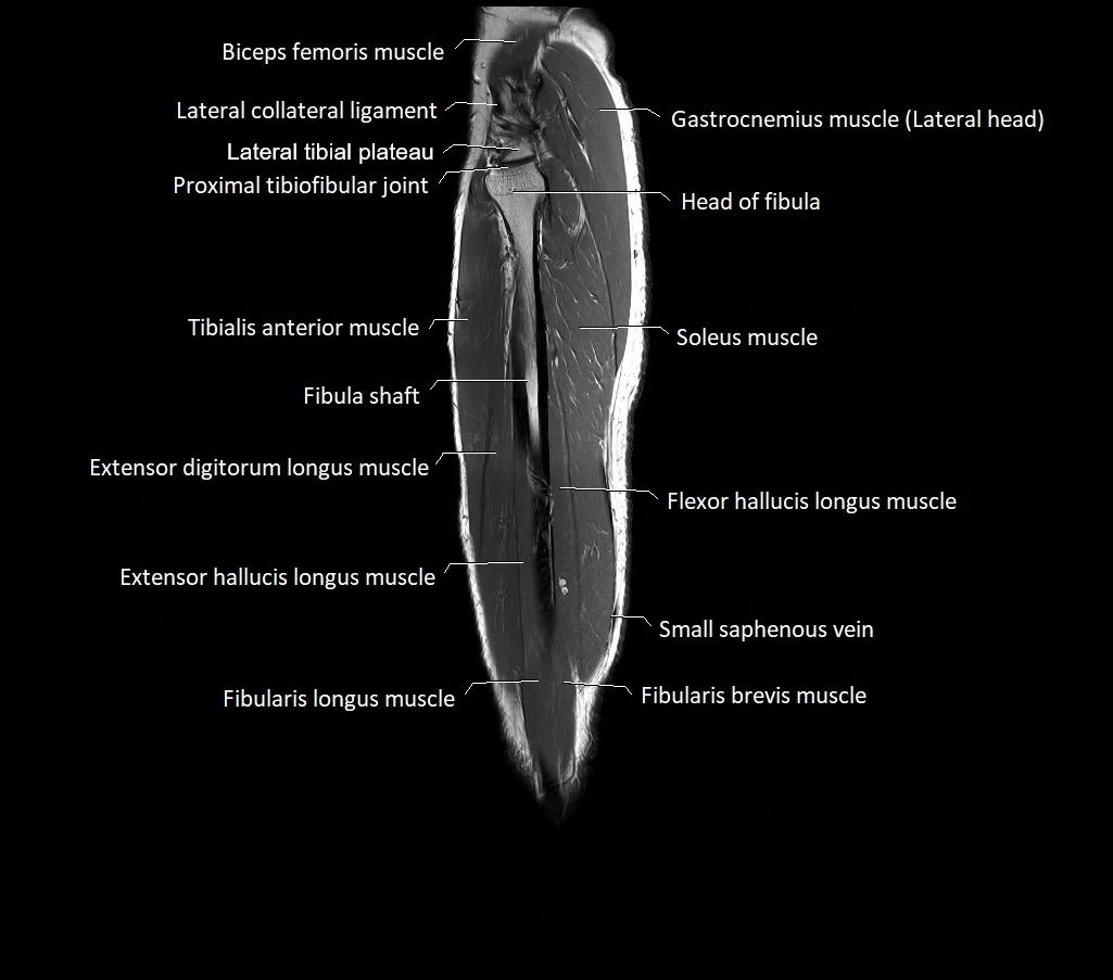 Lower leg sagittal anatomy 3T MRI image 9.webp